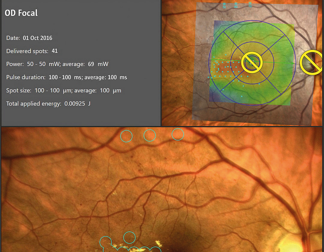 Focal Laser Photocoagulation I Navilas 577s